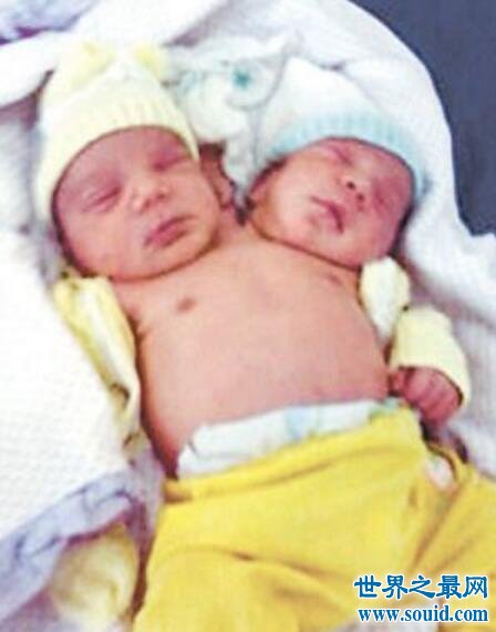 巴西双头婴儿，共用身体与心脏(异性双胞胎)