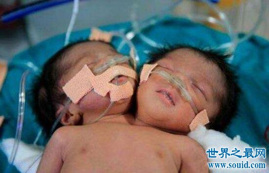 巴西双头婴儿，共用身体与心脏(异性双胞胎)